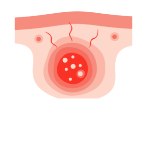 Abcès/Furoncle