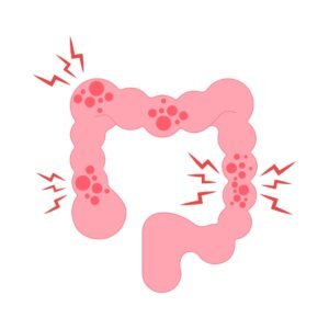 Colon irritable