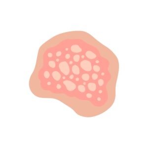 Dermatite séborrhéique