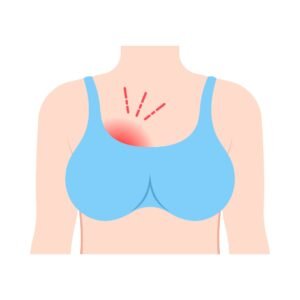 Engorgement mammaire