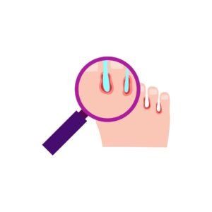 Mycose orteil / Pied d'athlète